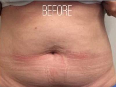 Abdomen fat removal to a patient with Coolsculpting for Abdomen treatment before.