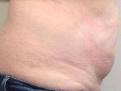 Close up stomach fat of a patient before coolsculpting.