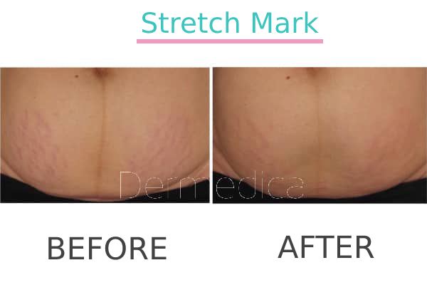 Stretch Mark treatment to a patient in Perth before and after.