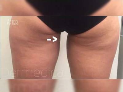 Coolsculpting in the thigh in Perth after.