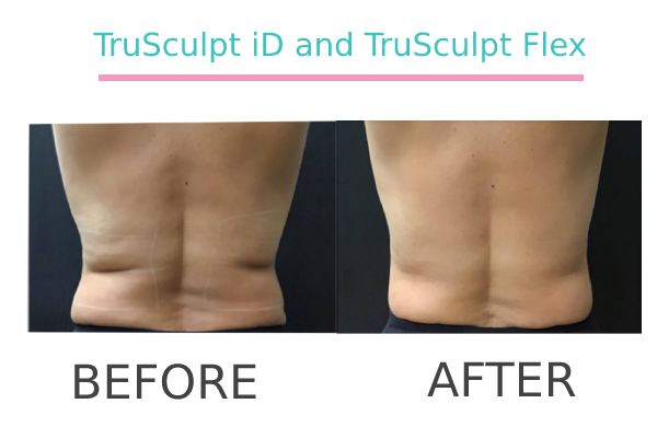 trusculpt treatment to a patient before and after.