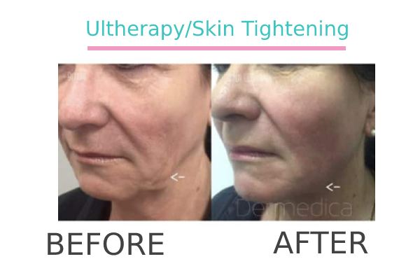 Ultherapy treatment to a patient before and after.