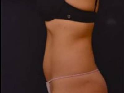 Non surgical liposuction method for patients in Perth before.