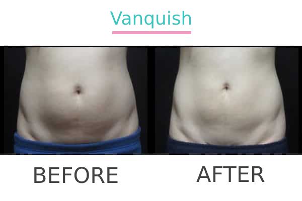 Vanquish treatment to a patient before and after.