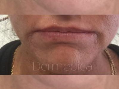 Nonsurgical Wrinkle treatment of a patient in Perth after.