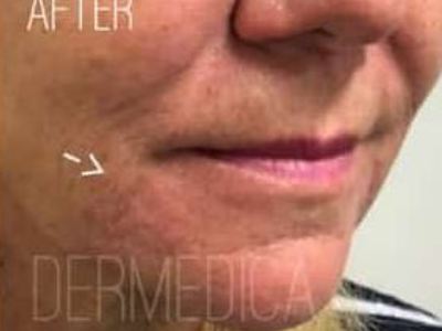 Nonsurgical Wrinkle treatment of a patient in Perth after.