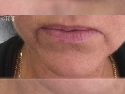Nonsurgical Wrinkle treatment of a patient in Perth before.