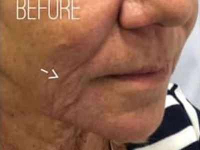 Nonsurgical Wrinkle treatment of a patient in Perth before.