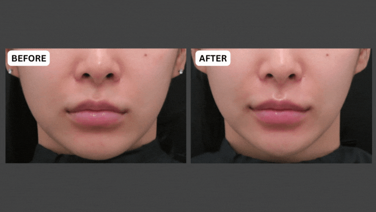 before and after jawline treatment