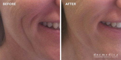 before and after cheek wrinkles filler treatment dermedica perth