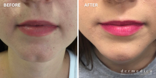 before and after chin filler treatment dermedica perth