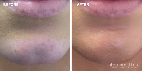 before and after chin filler treatment in perth dermedica