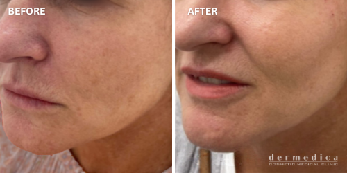 before and after dermal fillers cheeks dermedica perth