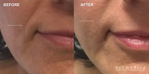 before and after nasolabial smile lines dermal filler perth dermedica