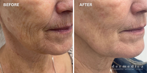 Before and after Collagen Biostimulator Injection Perth Dermedica
