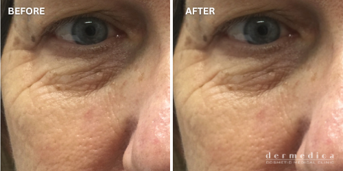 before and after around eye treatment perth dermedica - 3