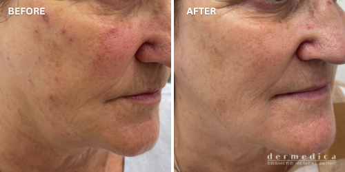 before and after clear complexion treatment perth dermedica