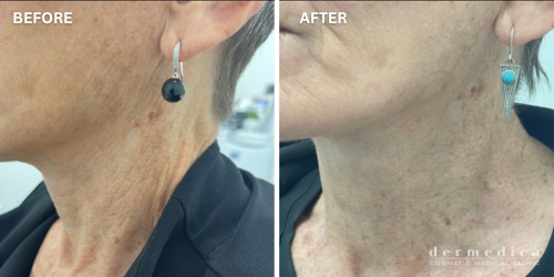 before and after collagen growth treatment