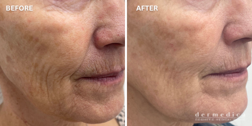 before and after collagen growth treatment perth deremedica