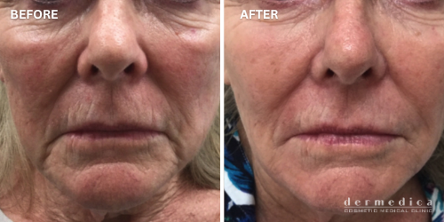 before and after laser facial dermedica perth