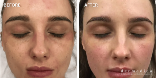 before and after laser facial perth dermedica