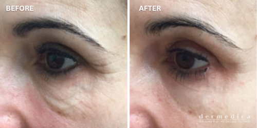 before and after laser facial under eye perth dermedica