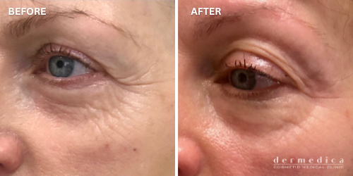 before and after skin lifting eyes teratment perth dermedica
