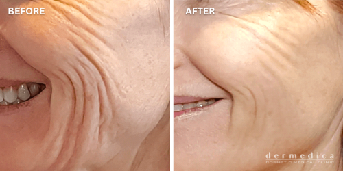 collagen growth treatment before and after perth dermedica - 1