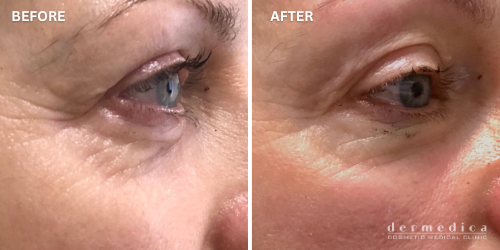 skin lifting eyes treatment before and after perth dermedica