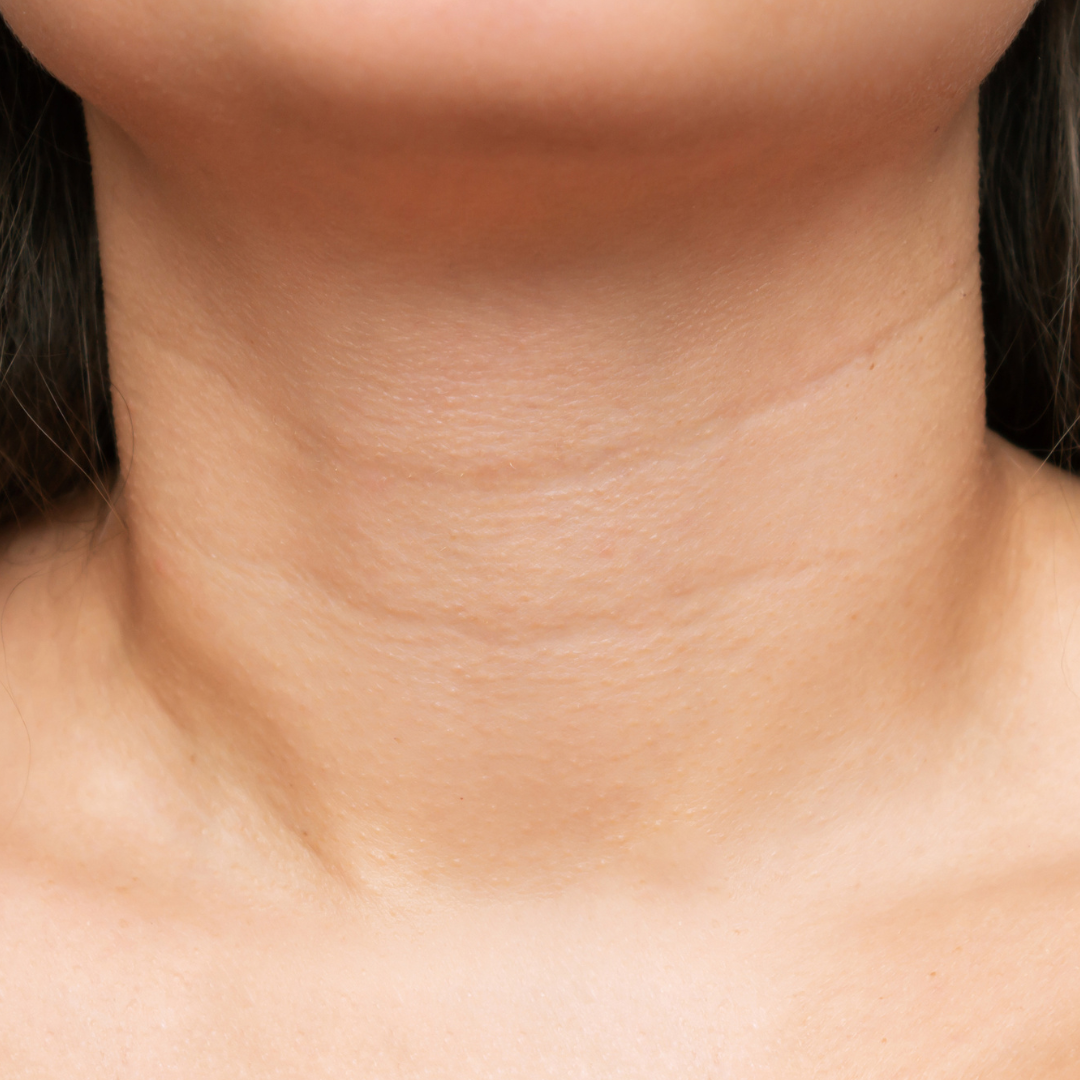 why you have neck wrinkles pigmentation