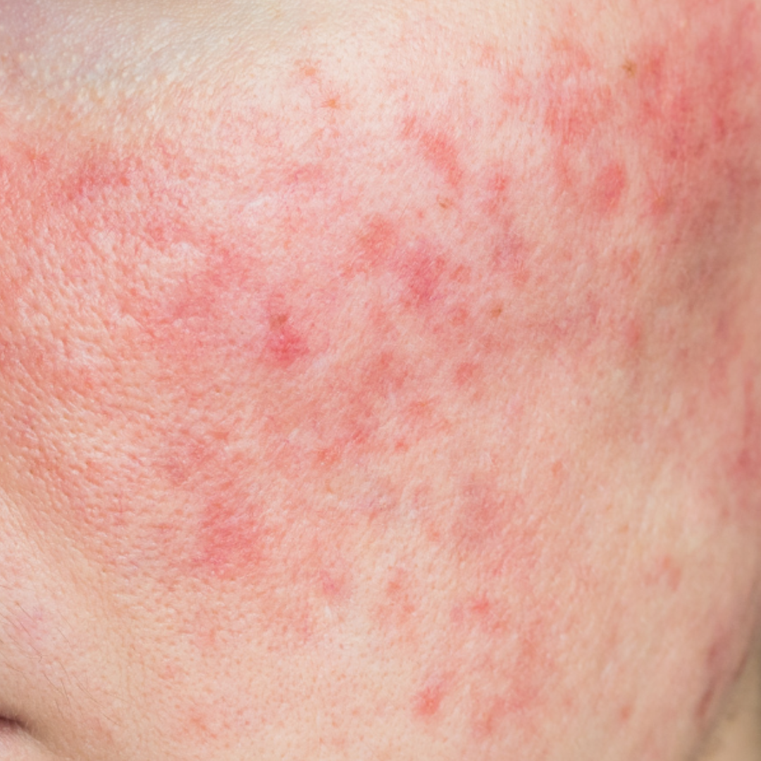why you have rosacea