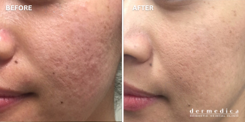before and after large pores treatment