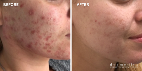 before and after acne treatment in dermedica perth