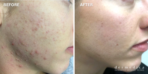 before and after acne treatment in perth dermedica