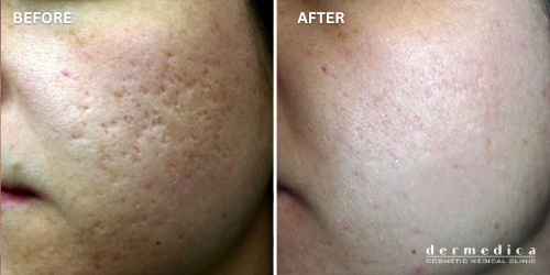 large pores treatment before and after