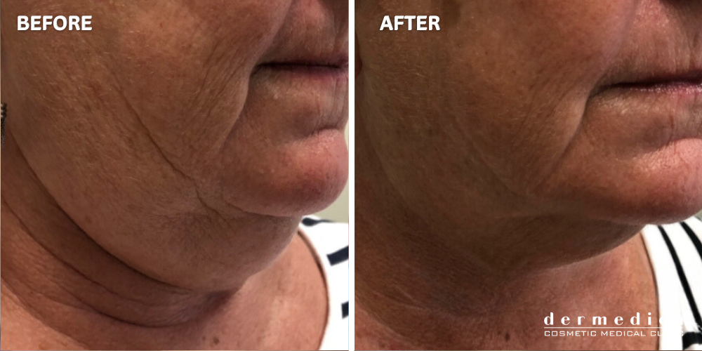 before and after double chin treatment in australia