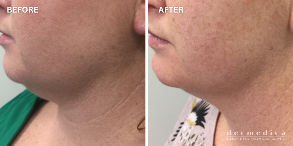 before and after double chin treatment in perth