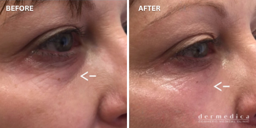 before and after under eye treatment dermedica perth