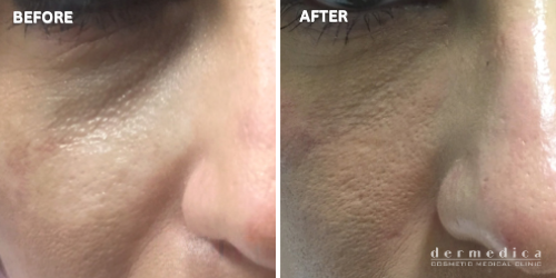 before and after under eye treatment dermedica perth