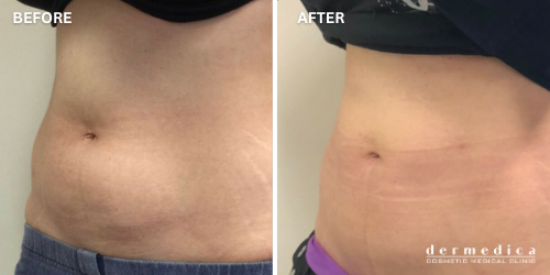 Before and after Coolsculpting fat reduction dermedica