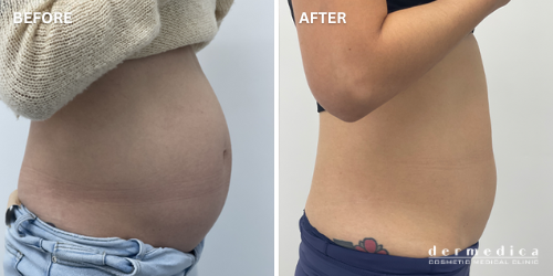 Before and after Coolsculpting fat reduction perth