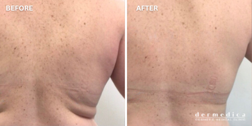 Before and after Coolsculpting fat reduction australia