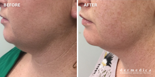 Before and after Coolsculpting fat reduction treatment