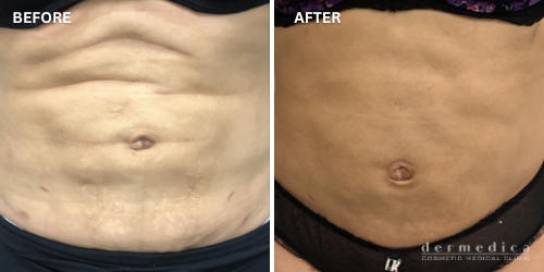 Before and after exilis body treatment for fat reduction