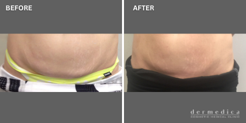 Before and after exilis body treatment for fat reduction perth
