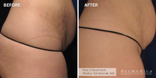 Before and after stretch mark treatment