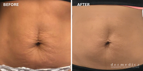 Before and after stretch mark treatment in perth