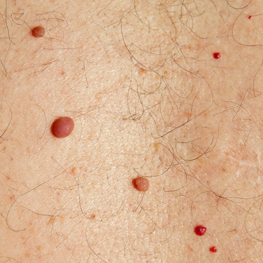 why you have cherry angiomas