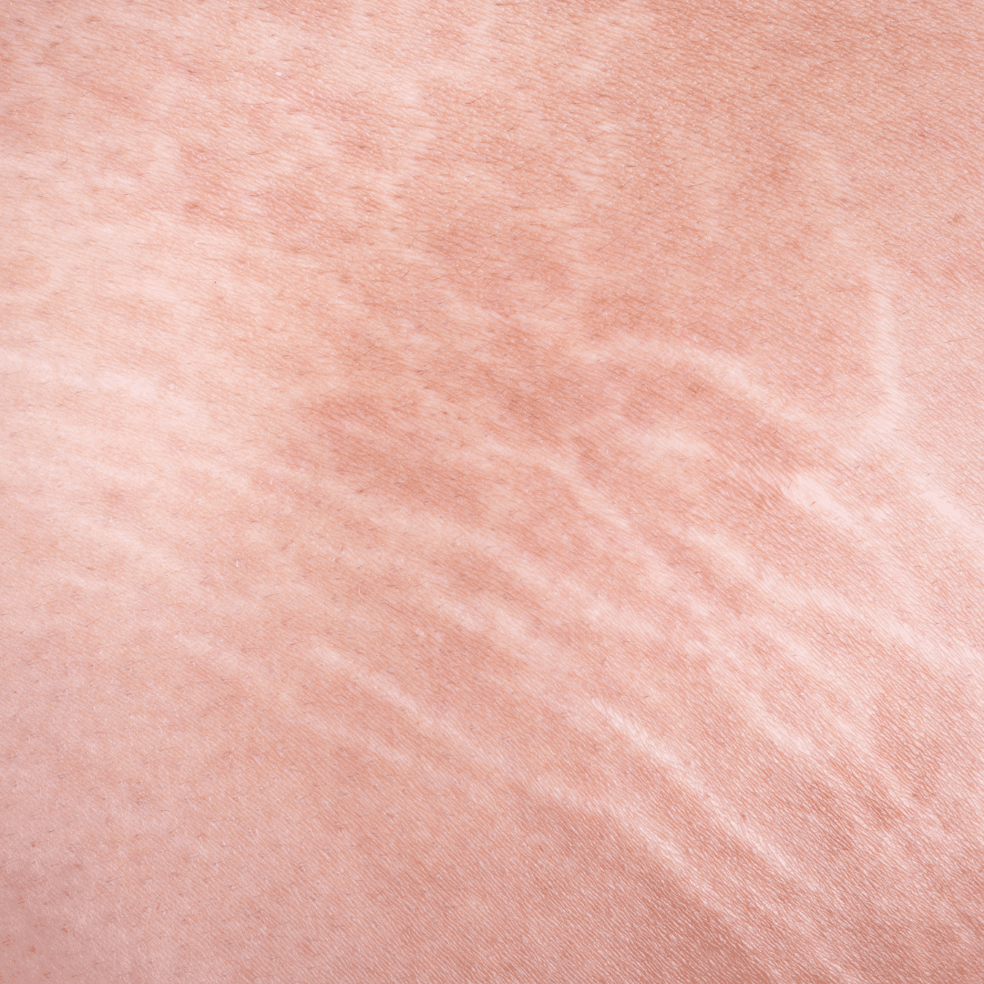 why you have stretch marks
