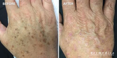 before and after ageing hands treatment in perth dermedica